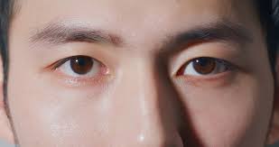 Asian Eye belpharoplasty